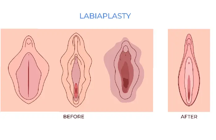 Labioplastia